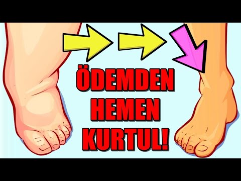 ÖDEM ATTIRAN DOĞAL YÖNTEMLER