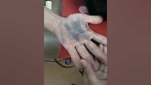 Đau nhức toàn thân - Bọ cạp bạc thải độc đánh gió