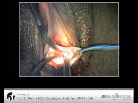 Cysts of Bartholin's Glands (SmartXide 2 - Jena Surgical) - YouTube