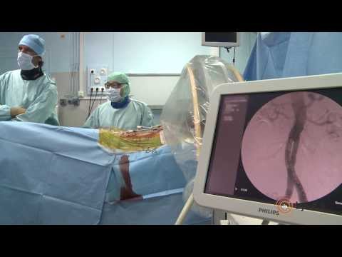 Vidéo: Anévrisme De L'aorte Abdominale - Symptômes, Traitement, Chirurgie, Rupture