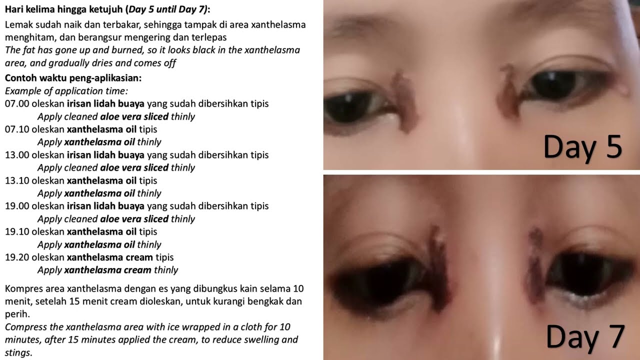 Cara Pakai Paket Xanthelasma Untuk Hilangkan Lemak Mata 