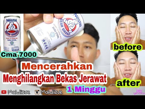 Cara Menghilangkan Bekas Jerawat N Memutihkan Wajah ...