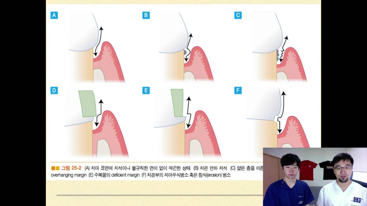 17-2-2 25장. 치석제거술 및 치근활택술