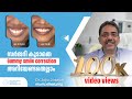 Gummy smile treatment without surgery drjojo joseph orthodontist vallamattam advanced orthodontic