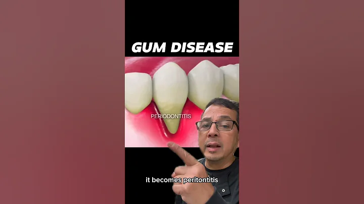 Understanding the Stages of Periodontal Disease | In Office to Hands On Dental Training #shorts