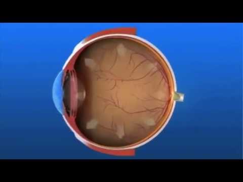 ما هو مرض الماء الأزرق ( الجلوكوما ) Glaucoma