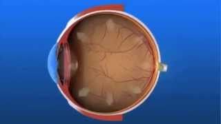 ما هو مرض الماء الأزرق ( الجلوكوما ) Glaucoma