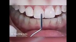 Composite veneers step by step 