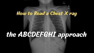 How to read a Chest X ray | the ABCDEFGHI approach | a guide for residents