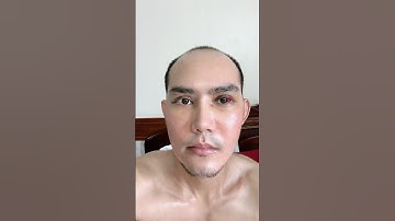 Kết quả cấy tóc dhi chữa hói đầu #caytoctuthan #caytoc #hairtransplant #caytocdhi #caubethoathoi