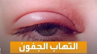 علاج انتفاخ جفن العين العلوي