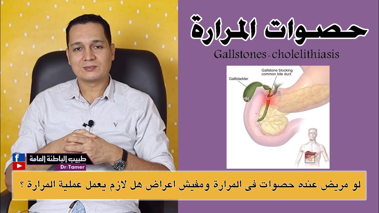 حصوات المرارة - هل يلزم الجراحة اذا كانت بدون اعراض ؟ / Gallstones - cholelithiasis
