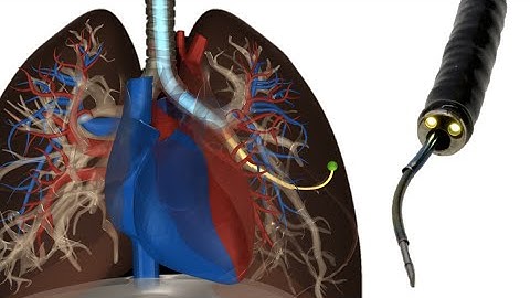 Transoral Steerable Needle Biopsy in the Peripheral Lung