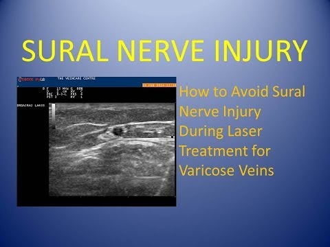 sural-nerve-injury---how-to-avoid-the-sural-nerve-during-laser-vein-treatment