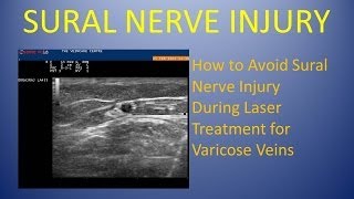Sural Nerve Injury - How to Avoid The Sural Nerve During Laser Vein Treatment