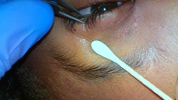 Botulinum toxin (Botox) injection to the lacrimal gland