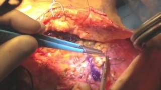 16 SMAS Plication and Platysmaplasty by Allen D Rosen, MD YouTube 360p