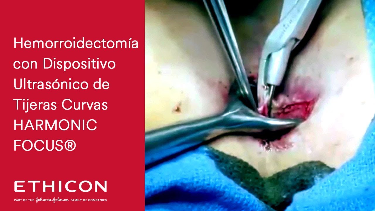 Mus Sustancial O cualquiera Hemorroidectomía con Dispositivo Ultrasónico de Tijeras Curvas HARMONIC  FOCUS - YouTube