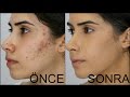 Sivilce-Akne ve Sivilce Lekesi Nasıl Kapatılır? Ⅰ How to Cover Acne & Acne Scars