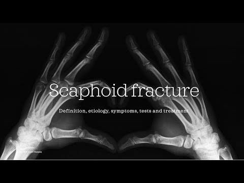 Scaphoid / Os Scaphoideum fracture [Essential medicine]