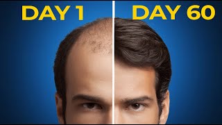 A Complete A to Z for Hair Loss Treatments