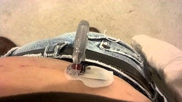 #2 Enlite Sensor- Trouble removing needle