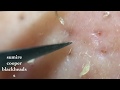 鼻角栓117.2nose blackheads（Larger version）★Tweezers only★