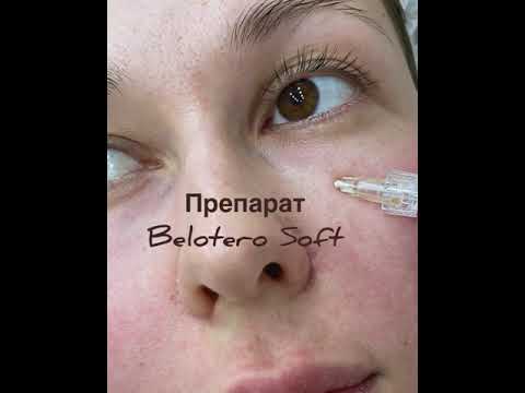 Коррекция носослезной борозды препаратом Belotero Soft в клинике "Анатомия"
