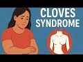 Topic: CLOVES Syndrome – Rare Disease in Humans (Class 12th Biology)#Science #MBBS #doctor #youtube