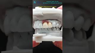 zirconia crowns with screw retained and cement retained.#dental #dentalprosthesis #china #aesthetic