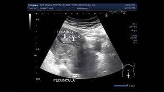Fibroid uterus type Pedunculated submucosal Fibroids.