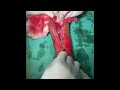 Upper Limb Fasciotomy - Post Electric Burn | Dr Awaneesh Katiyar | Caringsurgeon | Trauma Surgeon