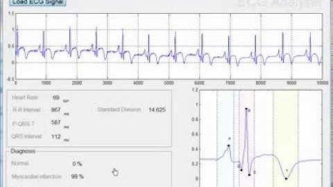 Automatic ECG Signal Analysis