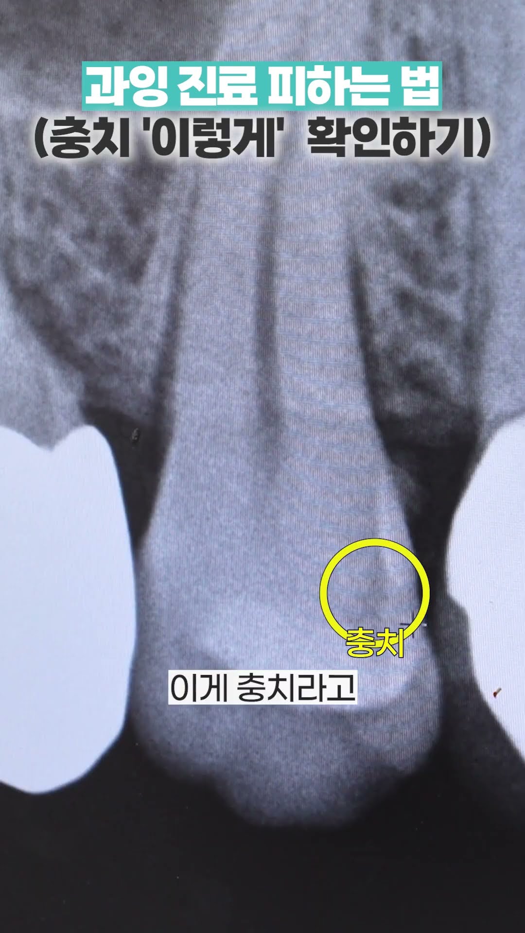 의사처럼 X-ray 보는 법? 과잉진료 피하고 싶은 분만 보세요.