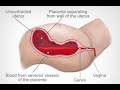 Postpartum Hemorrhage