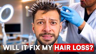 I tried a non FDA-approved hair loss treatment in Turkey