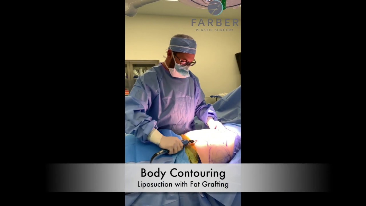 Body Contouring with Liposuction and Fat Grafting 