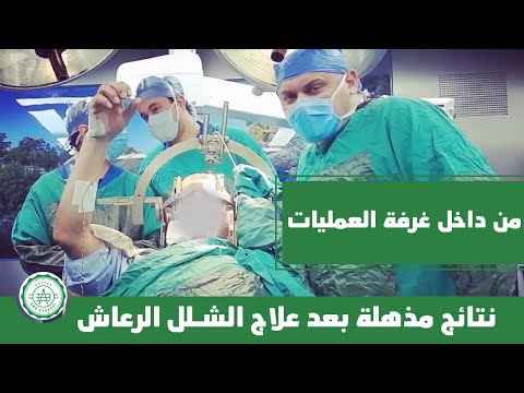 علاج الشلل الرعاش في جلسة واحدة وبدون جراحة الدكتور عمرو البكري 