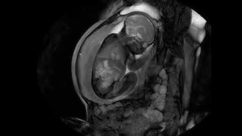 MRI scan at 32 weeks