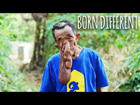 My Wart Turned Into A 1.5kg Tumour | BORN DIFFERENT