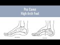 The best ways to take care of high arch feet