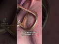 Fractional Laser فراكشنال ليزر Fractional Laser فراكشنال ليزر