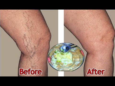 YOU WILL NOT BELIEVE WHAT I USE TO GET RID OF MY VARICOSE + SPIDER VEINS Goodbye To Varicose Veins
