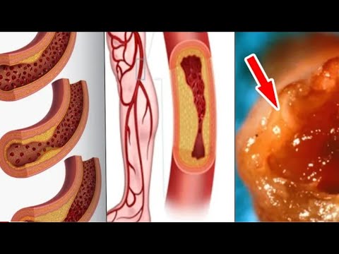 8 best remedies in the world that purify blood, arteries, eliminate excess cholesterol and +