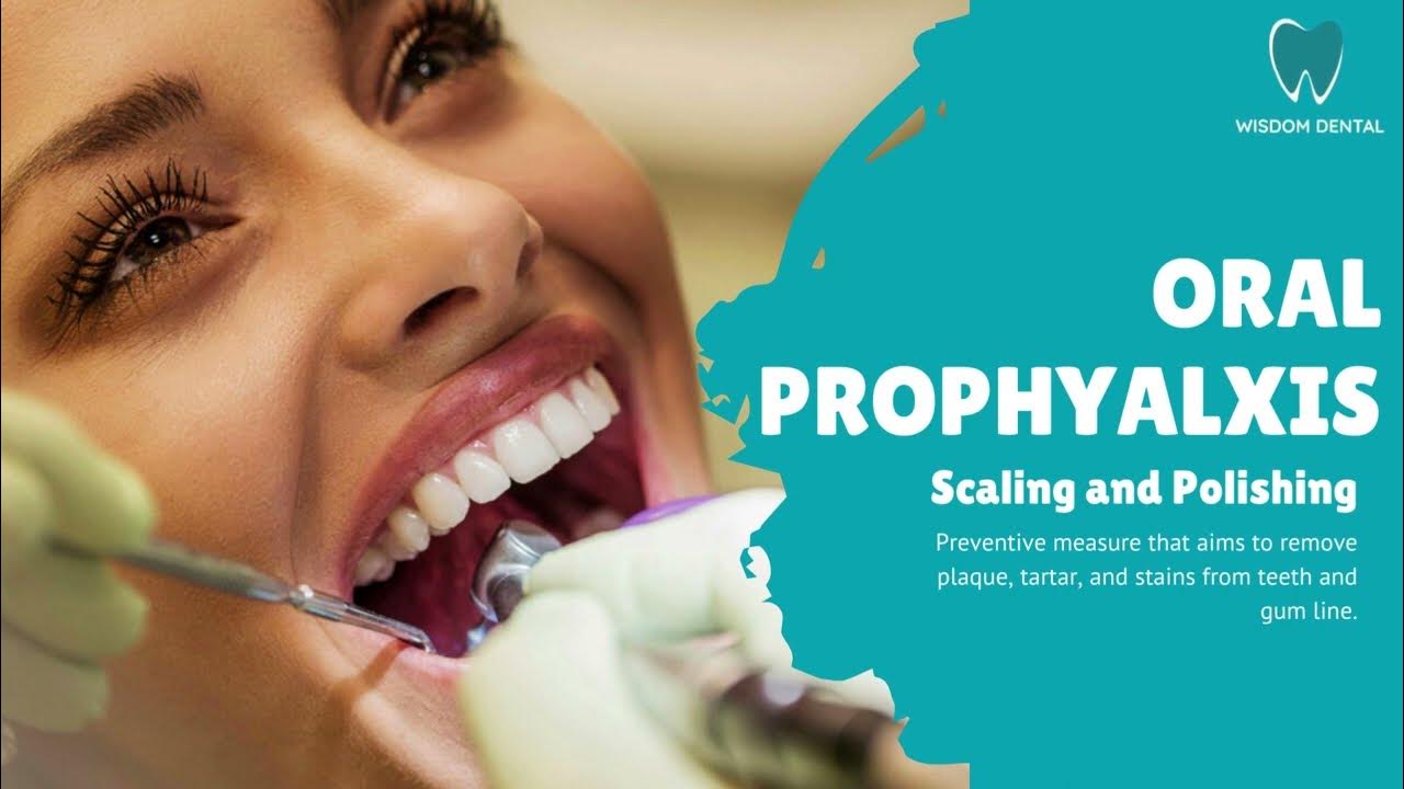 Oral Prophylaxis, commonly known as Scaling and Polishing. This video