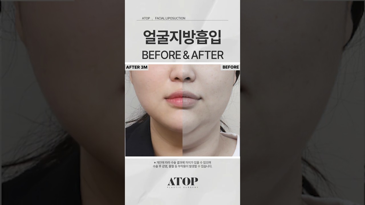 [Эйтоп Хуванцар мэс заслын эмнэлэг] Эмэгтэй хүний нүүрний өөх соруулах_сэтгэгдэл 1