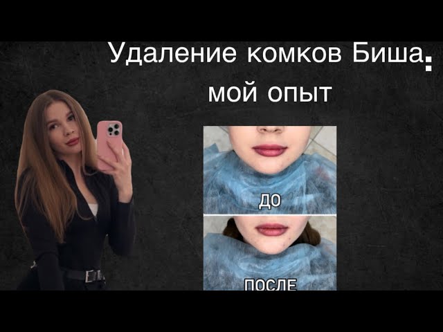 Удаление комков Биша: мой опыт