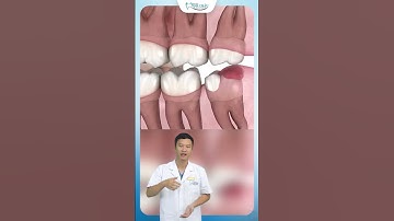 Tác hại Răng 8 Mọc Lệch | Bác Sĩ Yên