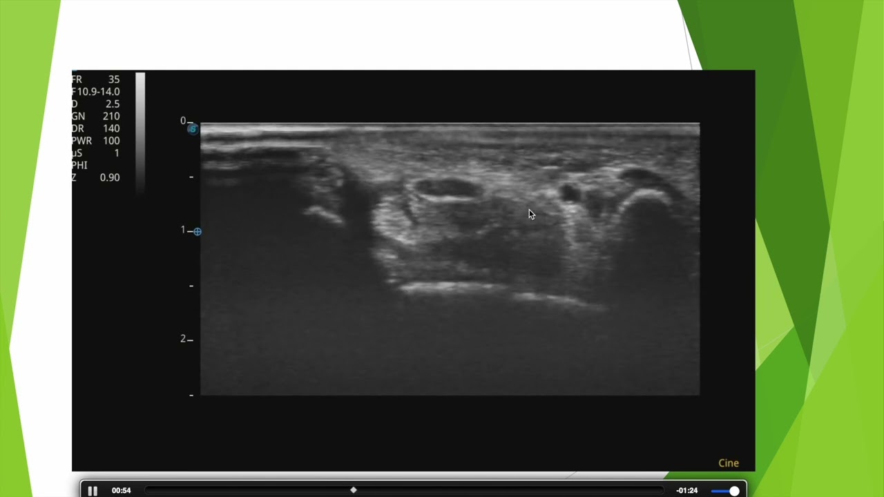 Repérer facilement le nerf médian en échographie au niveau du canal carpien