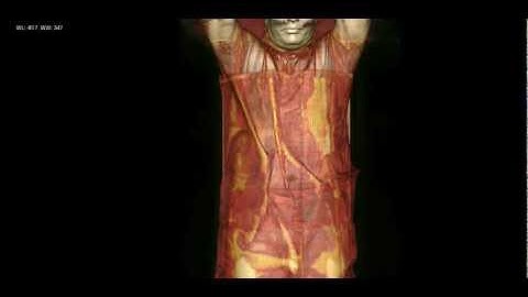 3d reconstruction ct scan